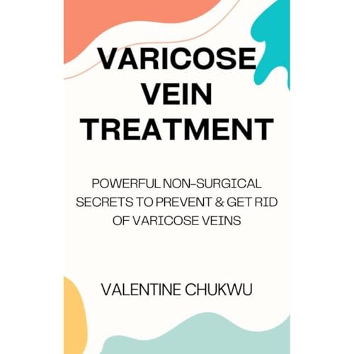 Varicose Vein Treatment by Valentine Chukwu