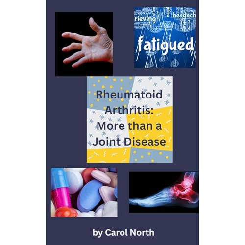 Rheumatoid Arthritis: More than a Joint Disease by Carol North